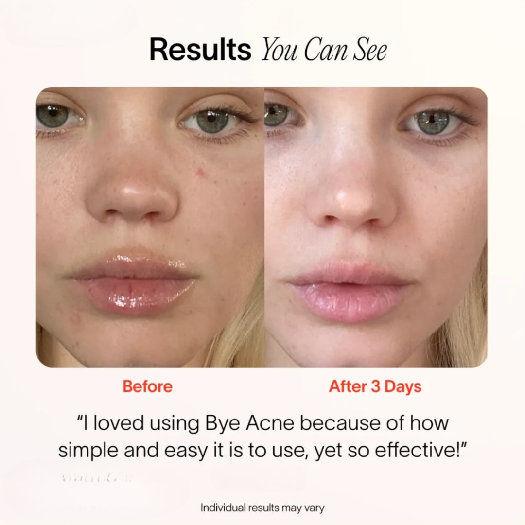 Bye Acne