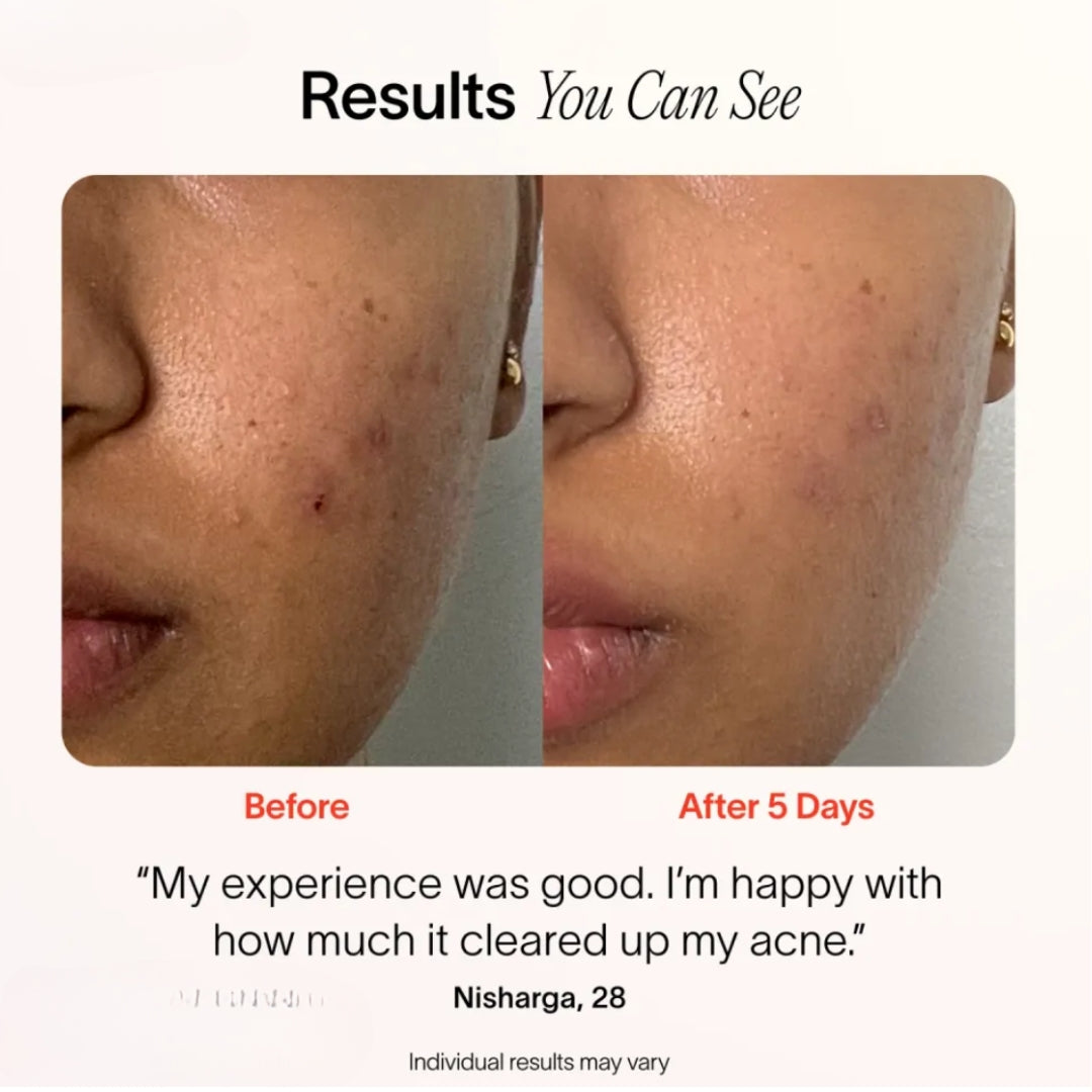 Bye Acne