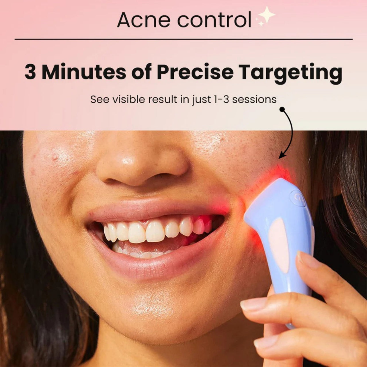 Bye Acne